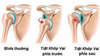 TRẬT KHỚP VAI - CHẤN THƯƠNG KHÔNG THỂ COI THƯỜNG