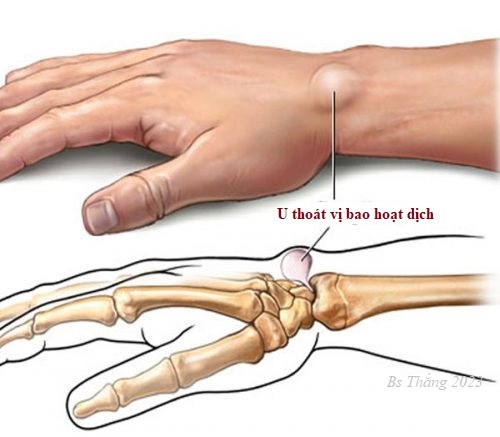 ĐIỀU TRỊ THOÁT VỊ BAO HOẠT DỊCH CỔ TAY